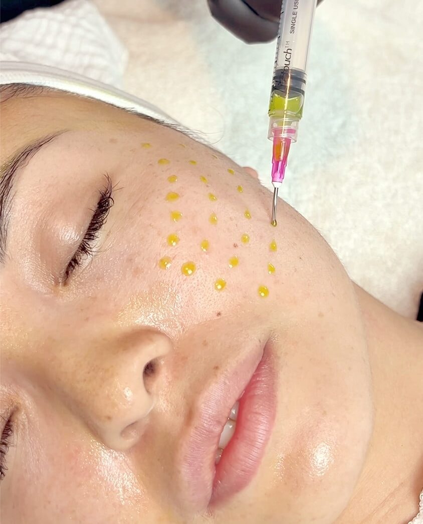 BIOREPEEL Chemical Peel